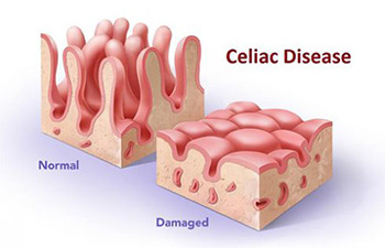 celiachia